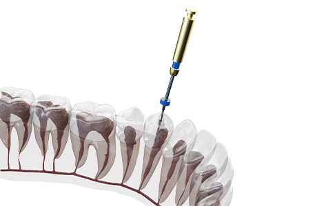 高度な技術と先端機器で大切な歯を残す根管治療