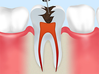 感染歯質の除去