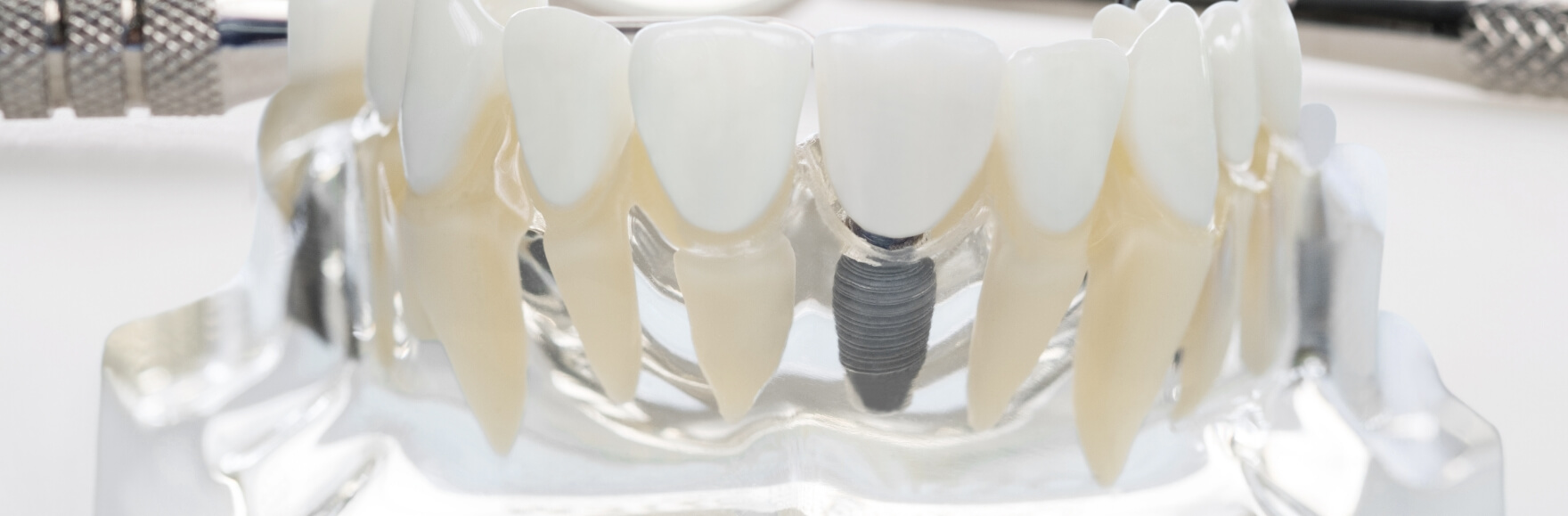 大切な天然歯を可能な限り残す・守る渋谷KU歯科の治療メニュー