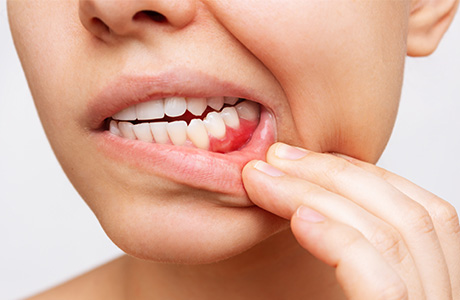 歯髄や歯周組織の炎症の原因になる