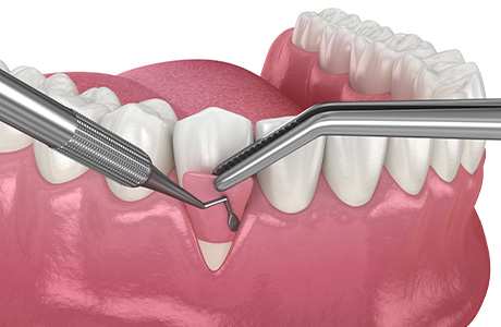 重度の歯周病を改善する外科的治療・再生療法にも対応