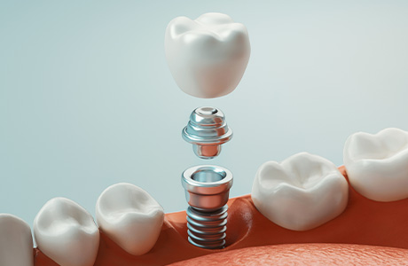 長持ちするインプラント治療は歯周病の治療から