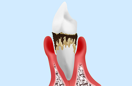 重度の歯周病でも歯を残せる歯周再生療法