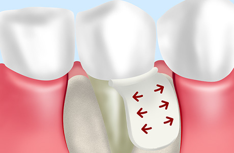 人工膜を用いて歯周組織の再生を誘導する～GTR法～