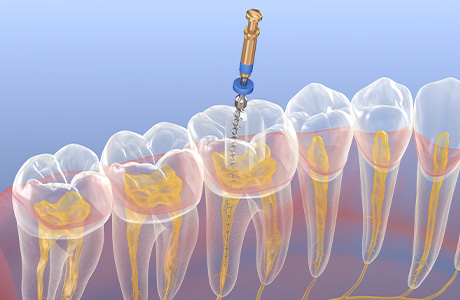 神経にまで達する重度の虫歯でも歯を残す根管治療